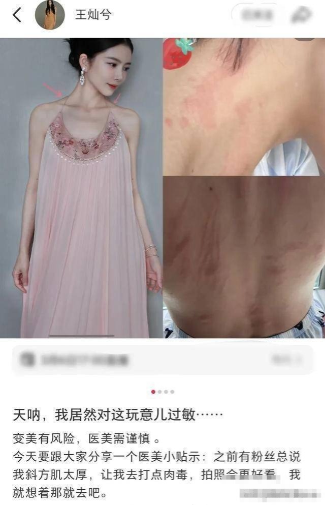 杜淳老婆医美出事，王灿打肉毒素过敏送医院，后背红痕累累插图